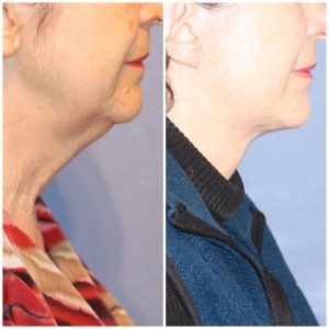 Lifting Cervicofacial (Cara y Cuello)  + Lipoinyección Facial